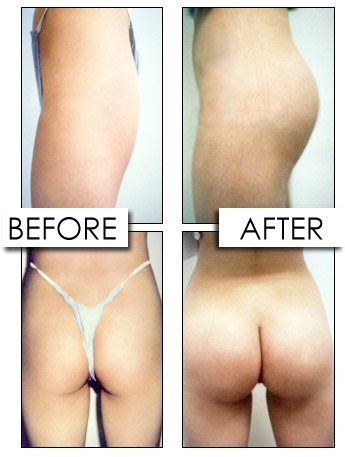 Buttock Implants / Augmentation Photos