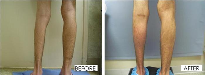 Calf Implants - Male Muscle Augmentation, Long Beach, Los Angeles