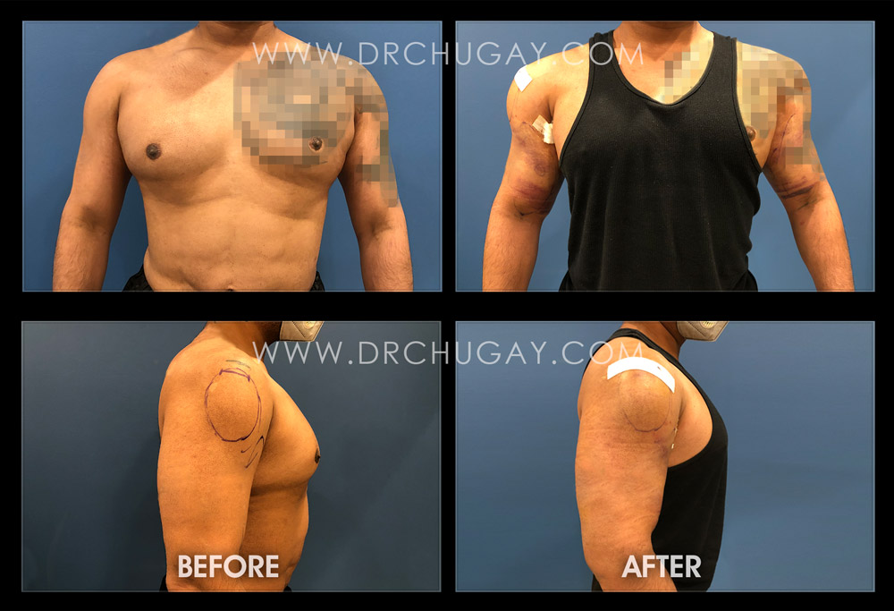 Biceps And Triceps Implants Photos, New York, NY