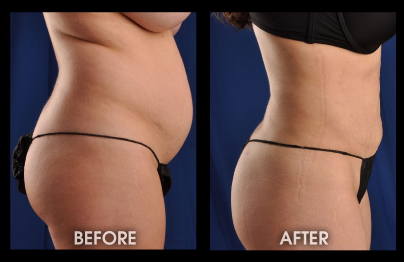 Is Liposuction Permanent? What You Need to Know - Clinic 360