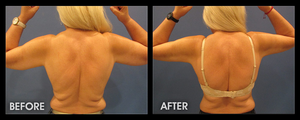 Total Transformations: Post-Bariatric Body Contouring Before & After