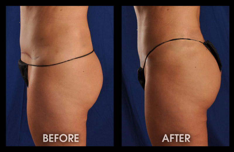 Buttock Implants / Augmentation Photos