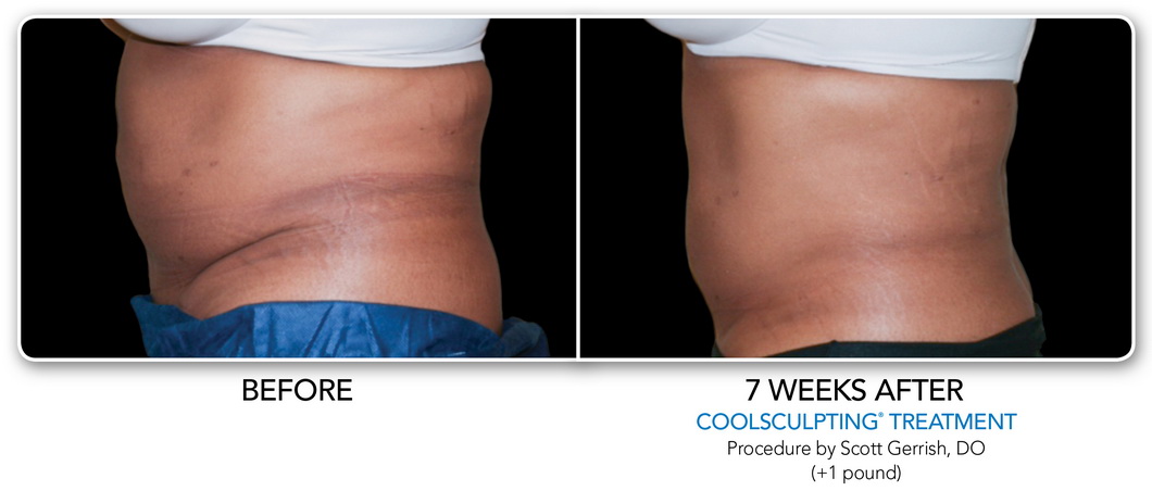 Before and After Galleries - CoolSculpting, CoolSmooth™, Long Beach
