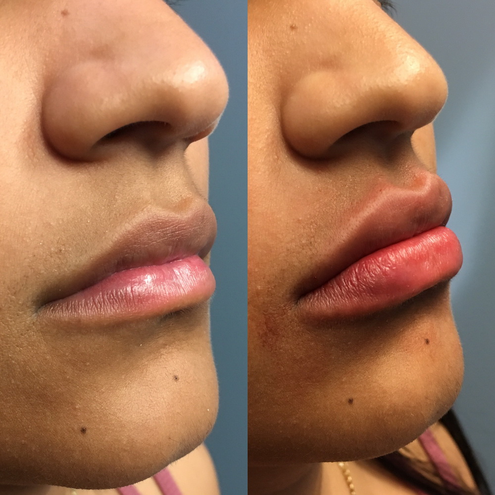 Juvederm Full Bodied Pouty Lips Long Beach Orange County