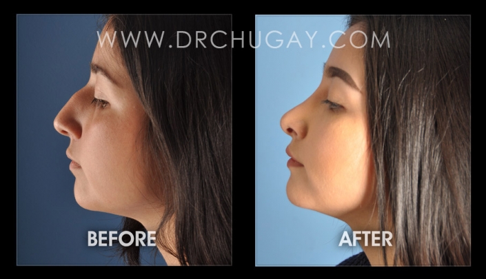 Rhinoplasty in Long Beach, Nose Job, Nose Sculpting, California