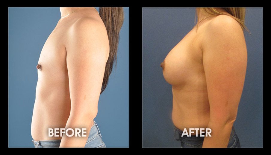 How Much Is A Boob Job?, Breast Augmentation Surgery Cost
